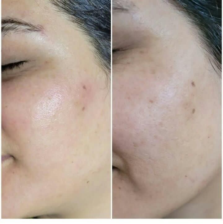 کربن تراپی صورت و بدن|خدمات آرایشگری و زیبایی|فردیس, فردیس|دیوار