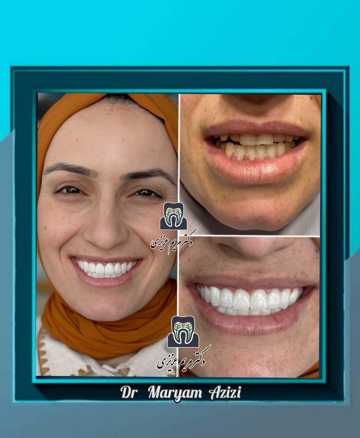 دندانپزشکی زیبایی و درمانی لمینت کامپوزیت دندان|خدمات آرایشگری و زیبایی|شیراز, معالی‌آباد|دیوار