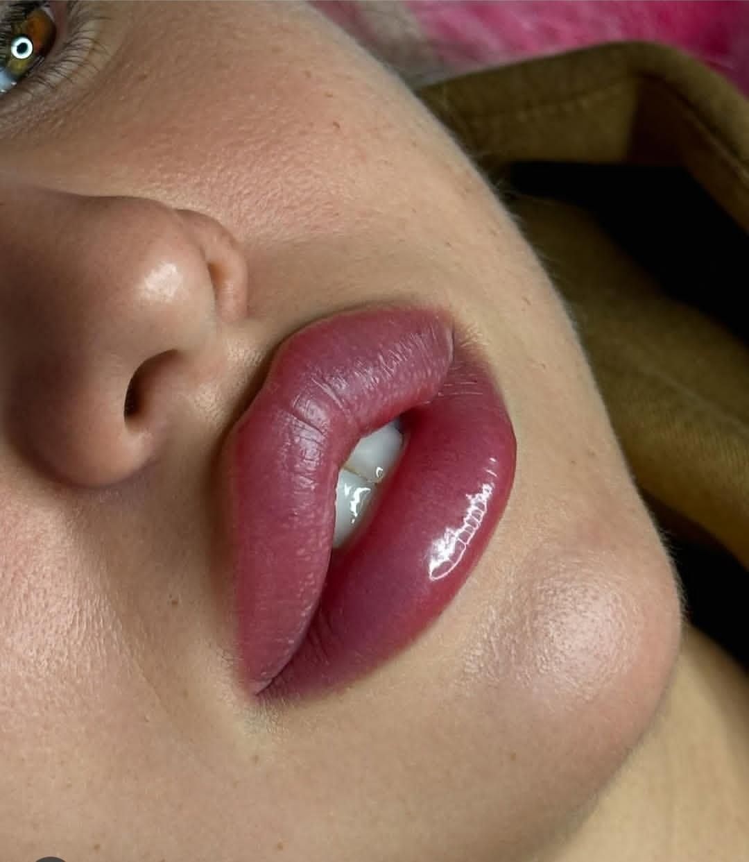 ژل بوتاکس فیلر زاویه سازی خط لبخند لیزر مطب پزشک|خدمات آرایشگری و زیبایی|قم, ارم|دیوار