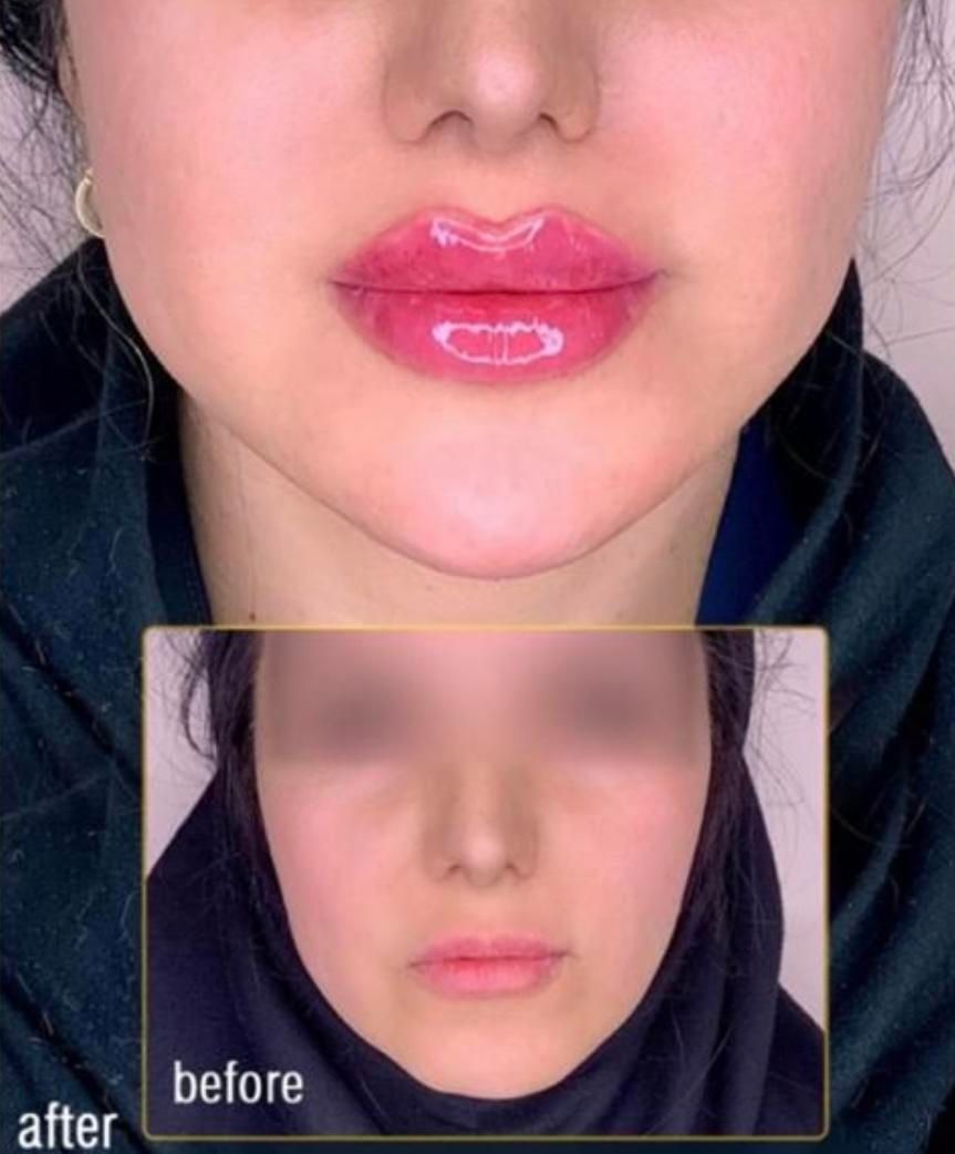 کلینیک تزریق ژل390لیفت بوتاکس لیزر جالپرو پروفایل|خدمات آرایشگری و زیبایی|تهران, صادقیه|دیوار