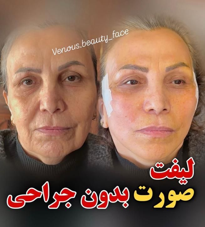 جشنواره50%تزریق ژل بوتاکس لیفت مزو لیزر توسط پزشک|خدمات آرایشگری و زیبایی|تهران, ستارخان|دیوار
