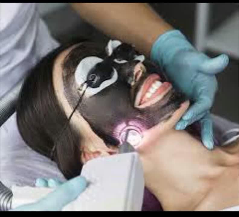 کربن تراپی صورت و بدن|خدمات آرایشگری و زیبایی|فردیس, فردیس|دیوار