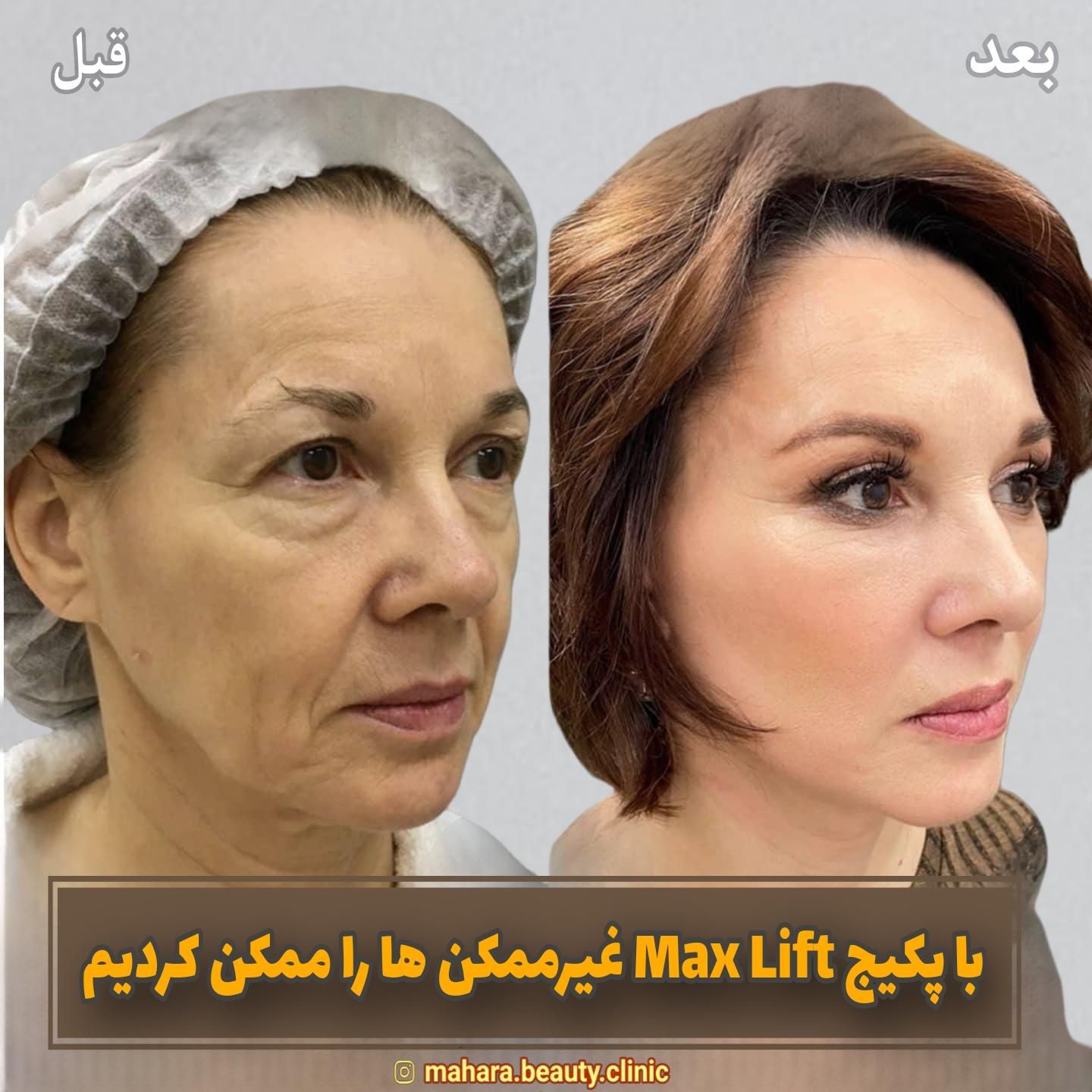 جشنواره جوانسازی Max Lift پزشک پوست مو بینی زیبایی|خدمات آرایشگری و زیبایی|مشهد, هفت تیر (حافظ)|دیوار