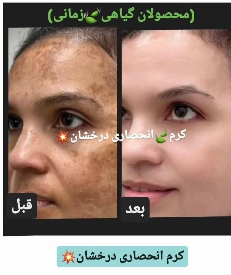 کرم ضدلک و روشن کننده درخشان(بدون بازگشت)|آرایشی، بهداشتی، درمانی|شیراز, قصرالدشت|دیوار