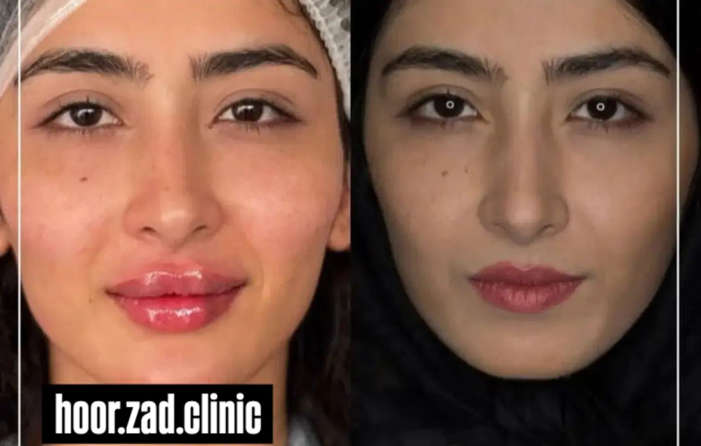 جشنواره پاییزه و افتتاح کلینیک بوتاکس وفیلر|خدمات آرایشگری و زیبایی|ارومیه, |دیوار