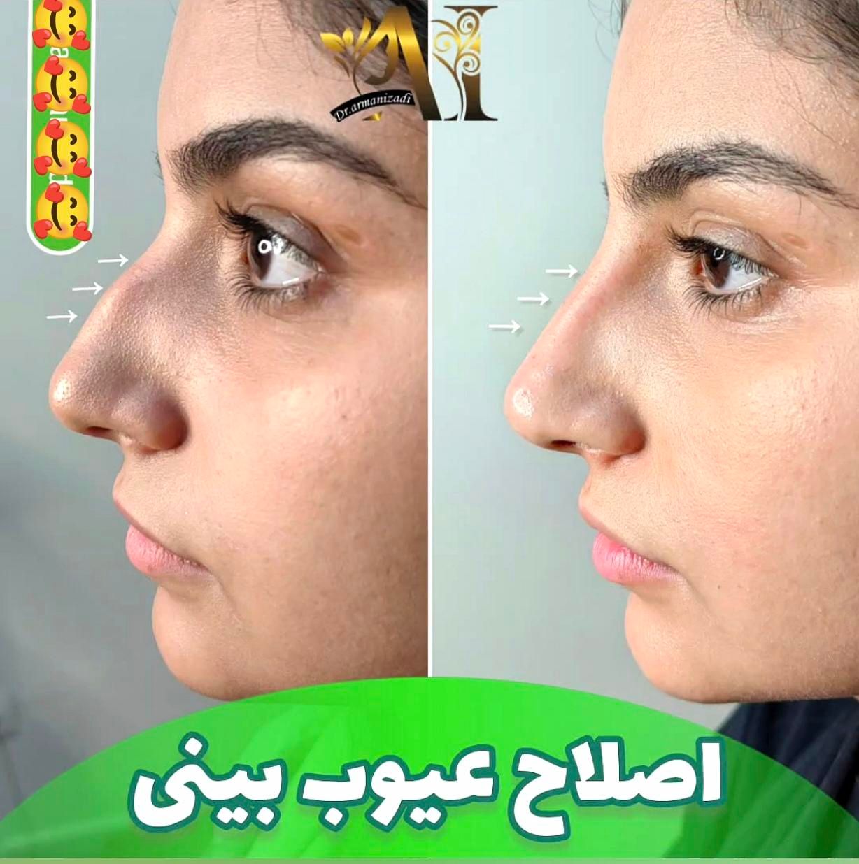 تزریق انواع بوتاکس  ژل آنزیم بینی نخ جوانسازی|خدمات آرایشگری و زیبایی|صدرا-فارس, فاز ۱|دیوار