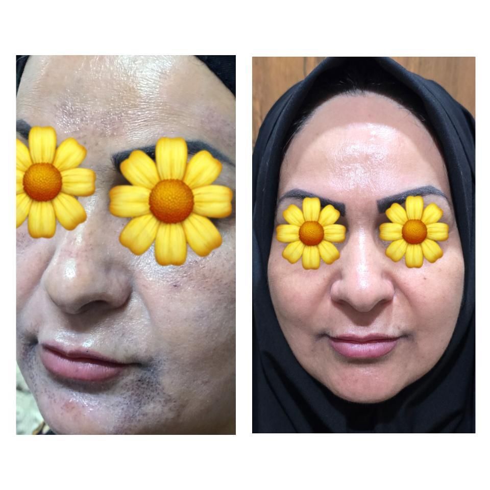 پاک کردن تتو  از بین رفتن لک و روشن کردن پوست|خدمات آرایشگری و زیبایی|اسلام‌شهر, شهرک واوان|دیوار