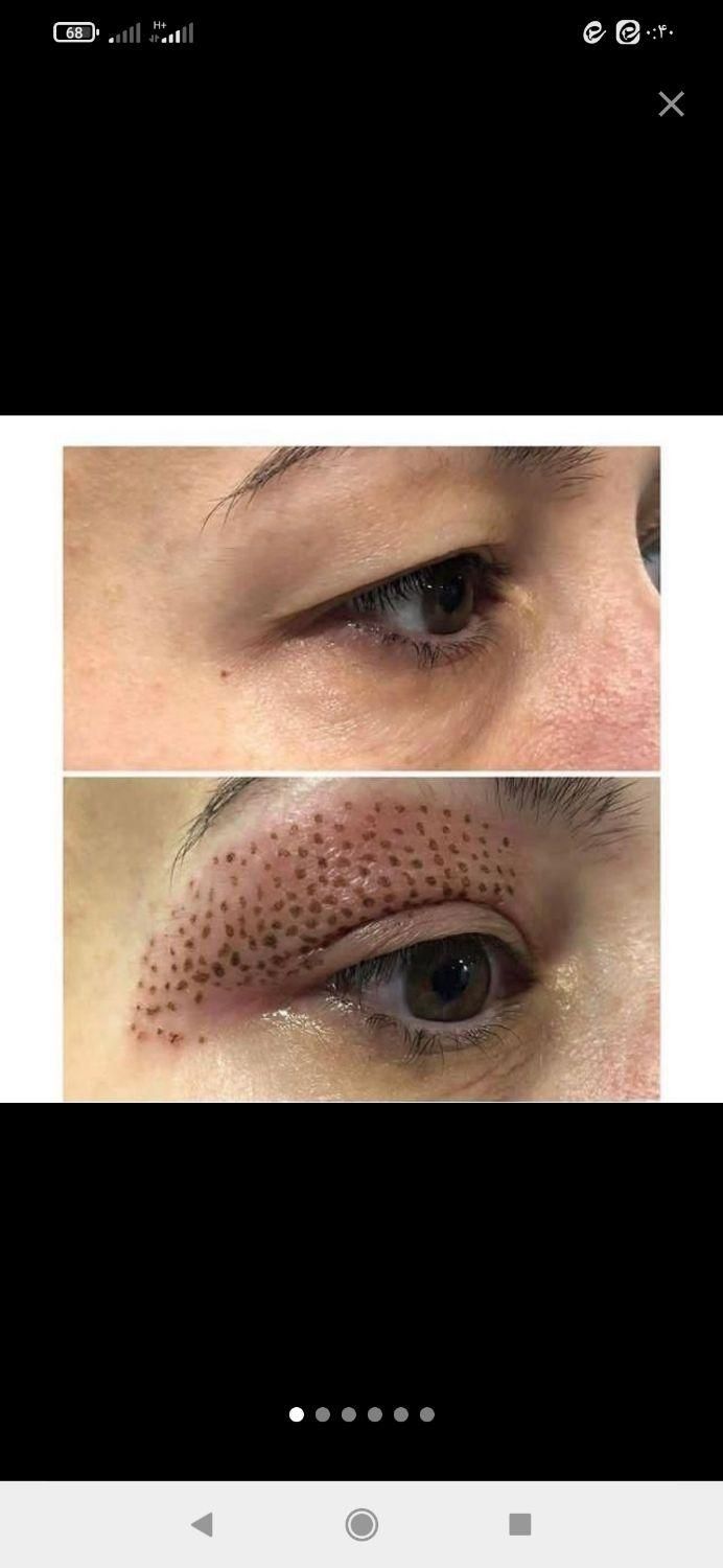 فیشیال تخصصی صورت وخالبرداری تخصصی وپلاسماتراپی|خدمات آرایشگری و زیبایی|قم, شهرک فاطمیه|دیوار