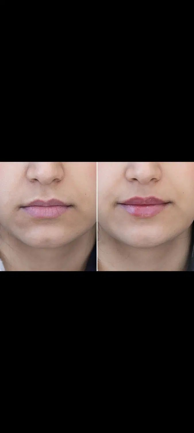 ژل لب فیلر بوتاکس مزو وآنزیم          زیرنظرپزشک|خدمات آرایشگری و زیبایی|مشهد, آزادشهر|دیوار