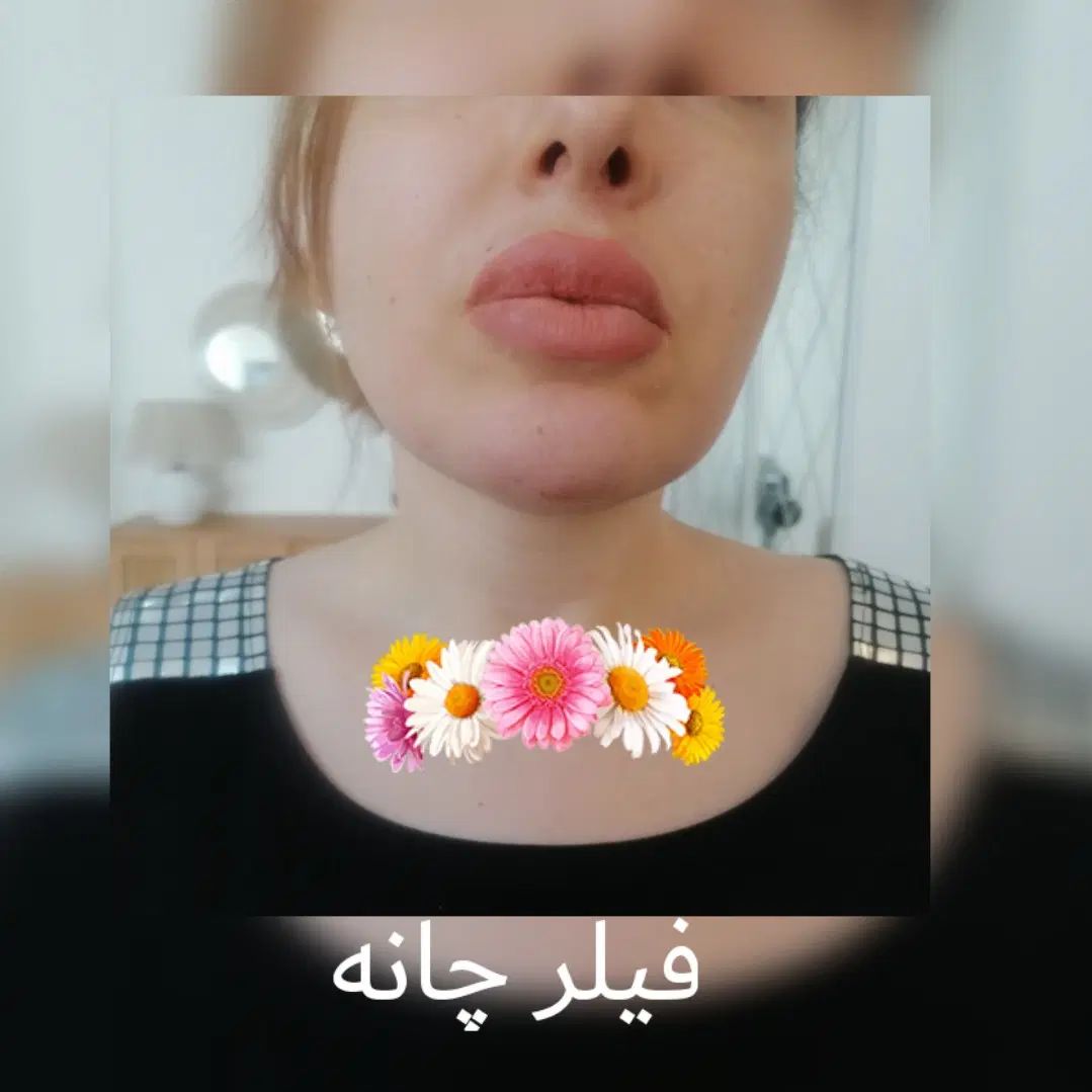 بوتاکس. فیلر. مزوتراپی. فشیال|خدمات آرایشگری و زیبایی|تهران, زاهد گیلانی|دیوار