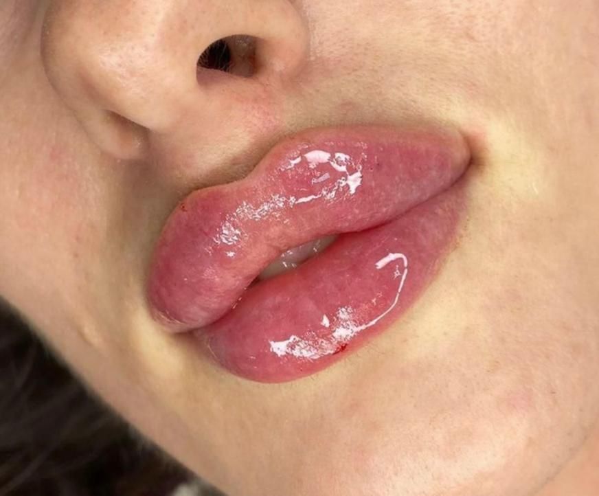 ژل بوتاکس چربی نخ|خدمات آرایشگری و زیبایی|ارومیه, |دیوار