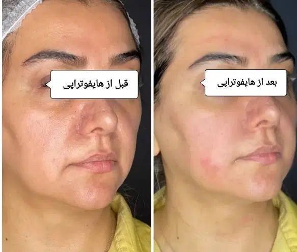 مرکز تخصصی جوانسازی اندولیفت/انواع هایفو/لیفت ۸۵۰ت|خدمات آرایشگری و زیبایی|اصفهان, احمدآباد|دیوار