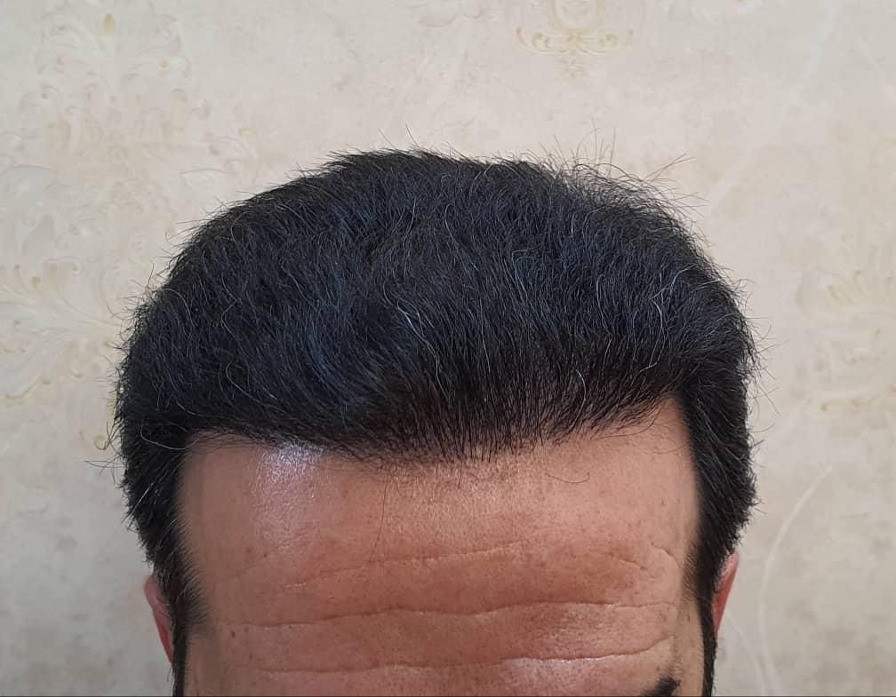 بهترین کلینیک کاشت مو و ابرو کرج و تهران|خدمات آرایشگری و زیبایی|کرج, جهان‌شهر|دیوار