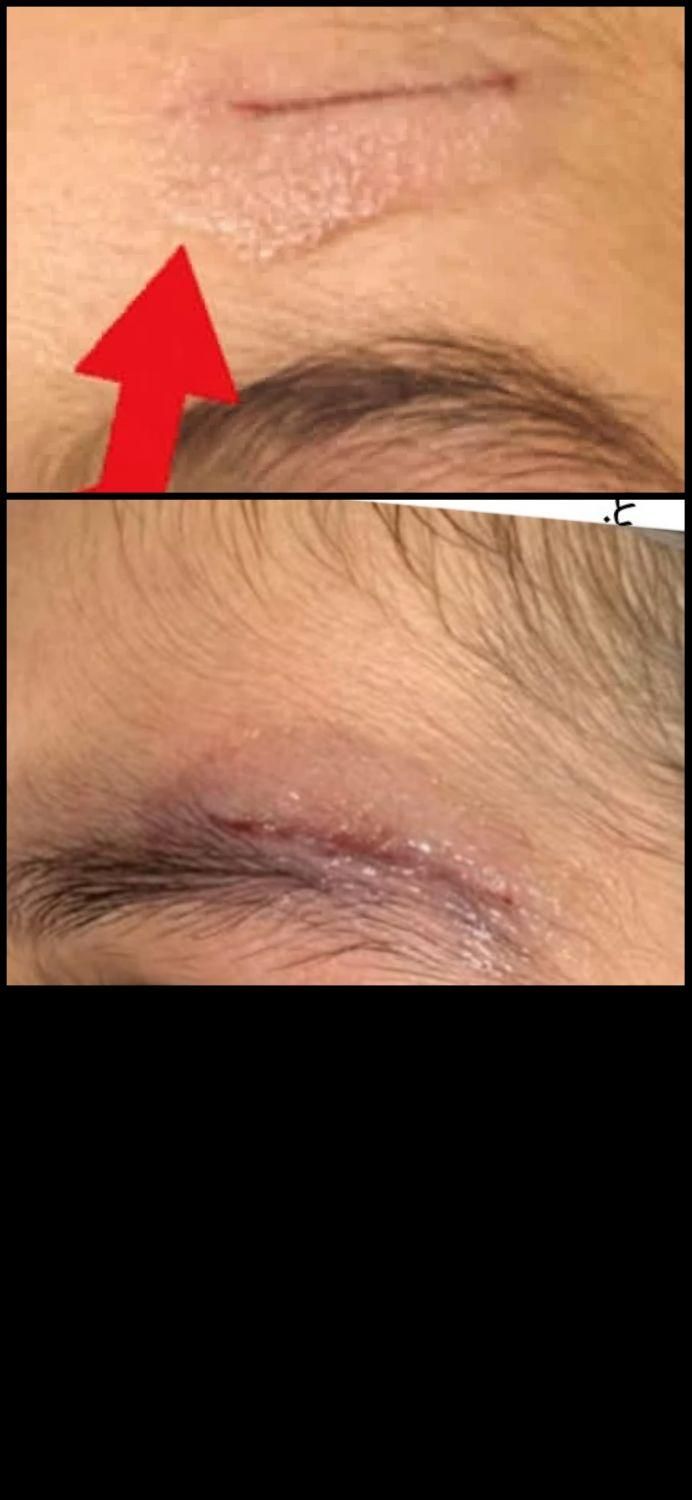 چسپ مایع ترمیم کننده ی زخم exofin آمریکایی وارداتی|خدمات آرایشگری و زیبایی|رفسنجان, |دیوار