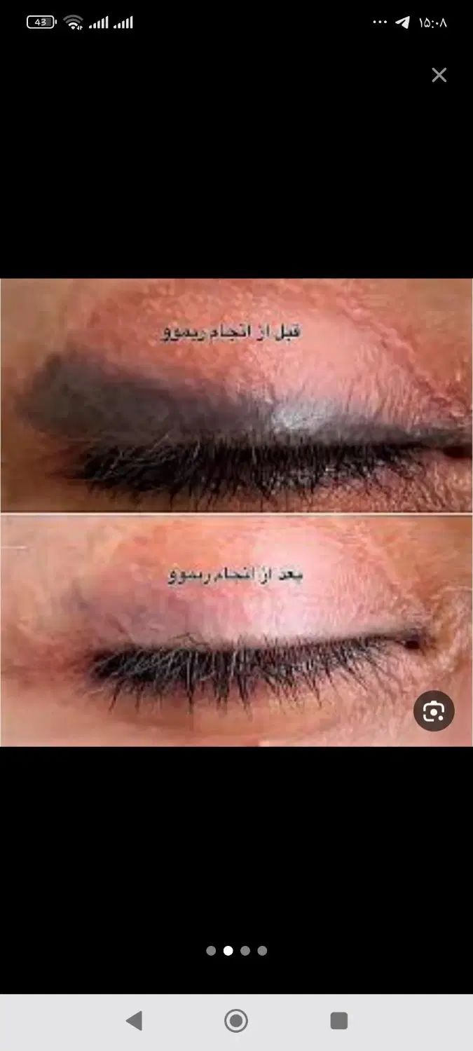 ریمو تتو با ۵۰درصد تخفیف با دستگاه کیوسویچ|خدمات آرایشگری و زیبایی|ساری, |دیوار