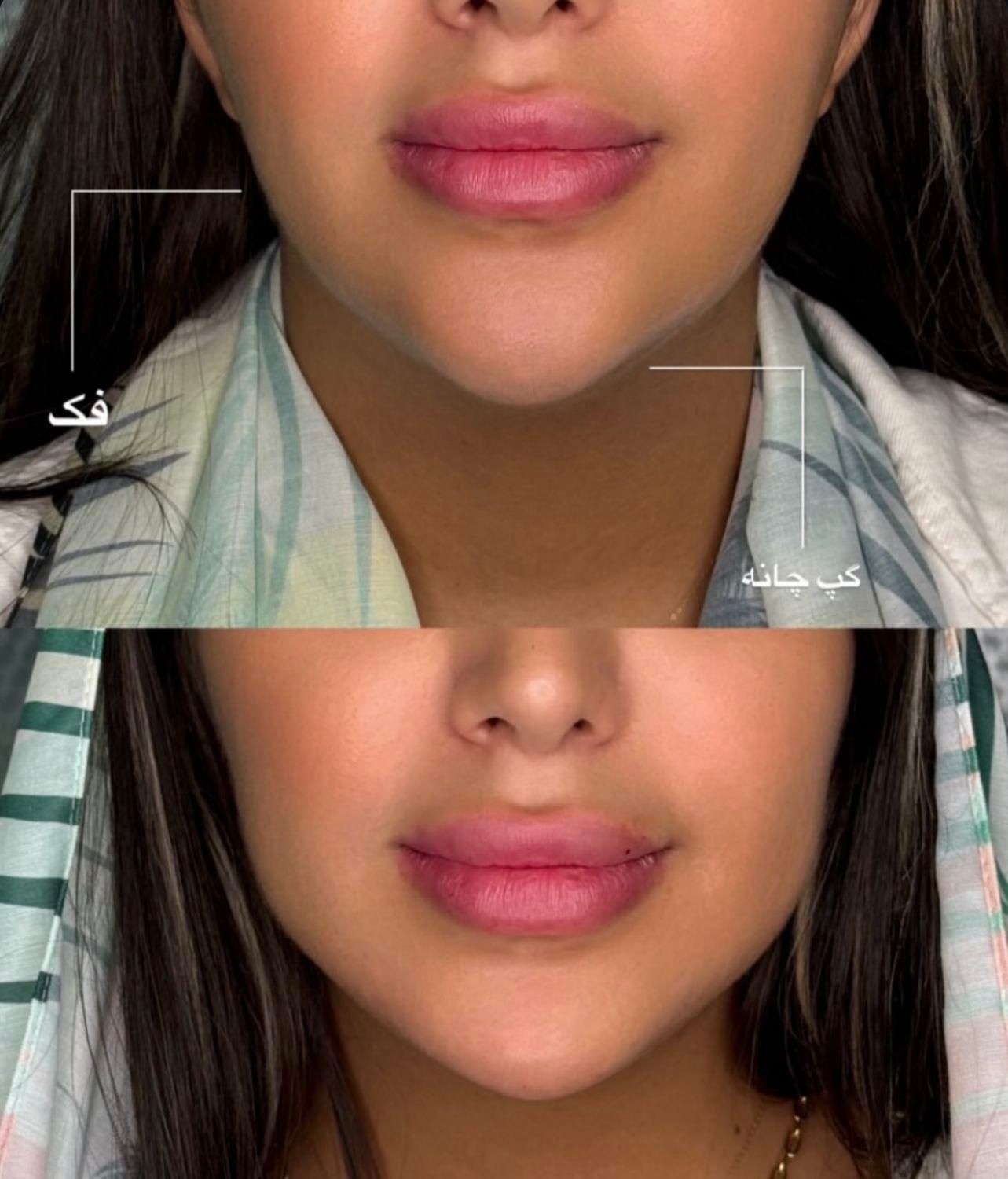 تزریق لب روسی/فیلر بادی/بوتاکس/مزوژل/prp|خدمات آرایشگری و زیبایی|تهران, تهرانپارس غربی|دیوار