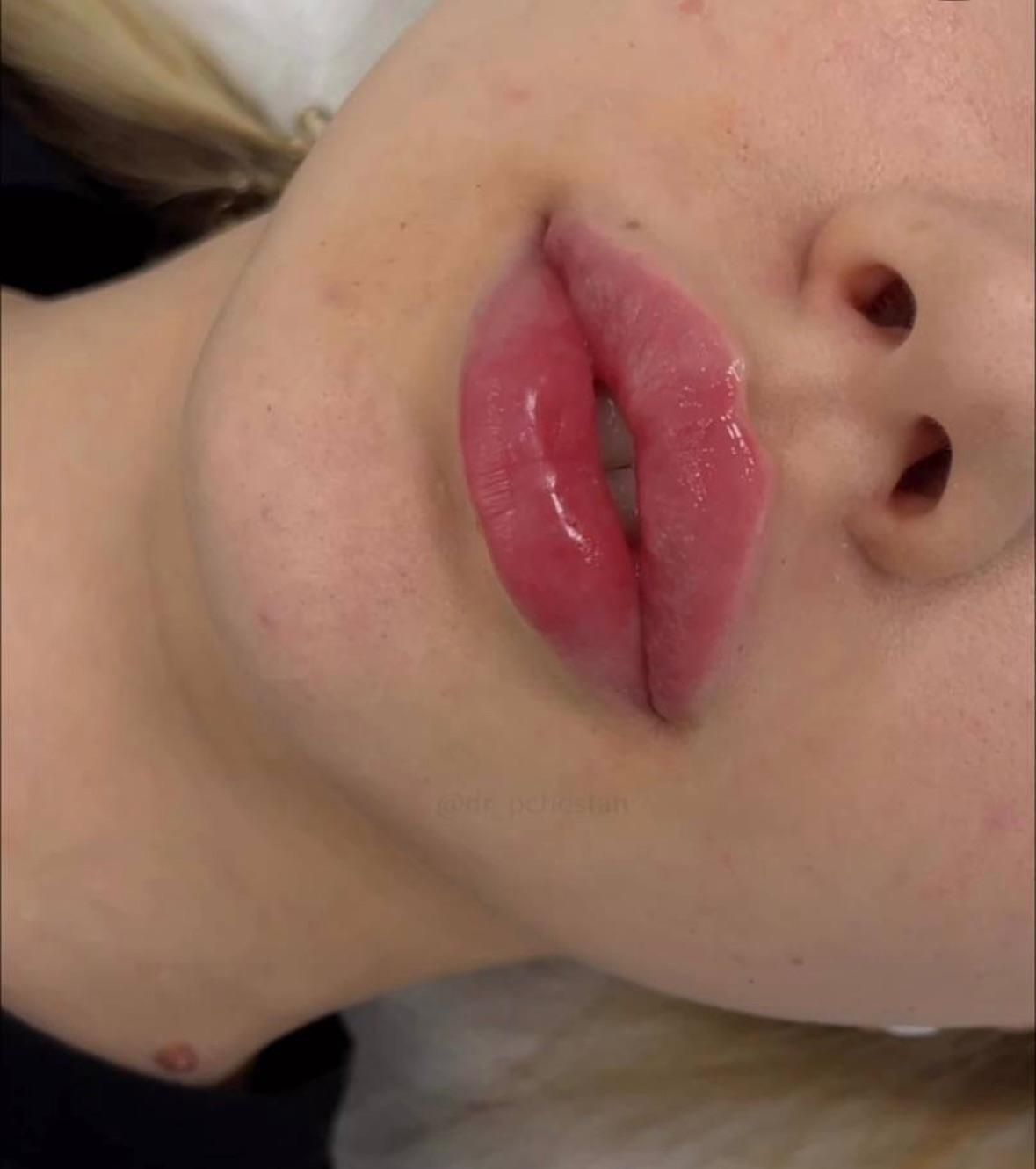 تخفیفات ژل و بوتاکس در مطب پزشک|خدمات آرایشگری و زیبایی|سنندج, |دیوار