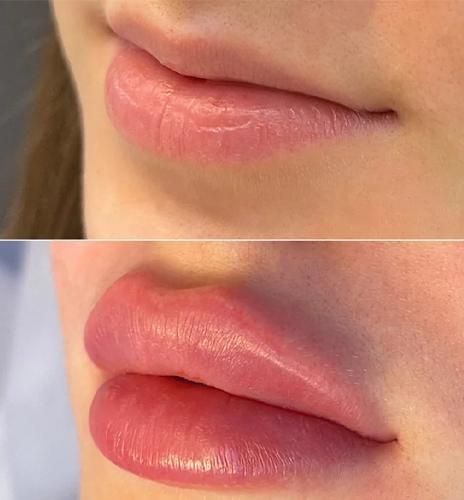خدمات ژل بوتاکس فیلر آنزیم مزوتراپی مزوژل|خدمات آرایشگری و زیبایی|تهران, دریان‌نو|دیوار