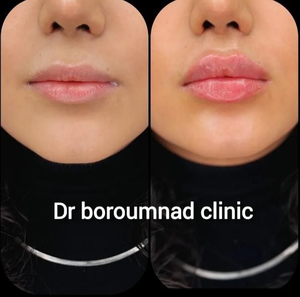 فیلر/ ژل لب تخصصی ۱.۳۰۰ ، بوتاکس پیشانی / لیفت۷۶۰|خدمات آرایشگری و زیبایی|مشهد, هدایت|دیوار