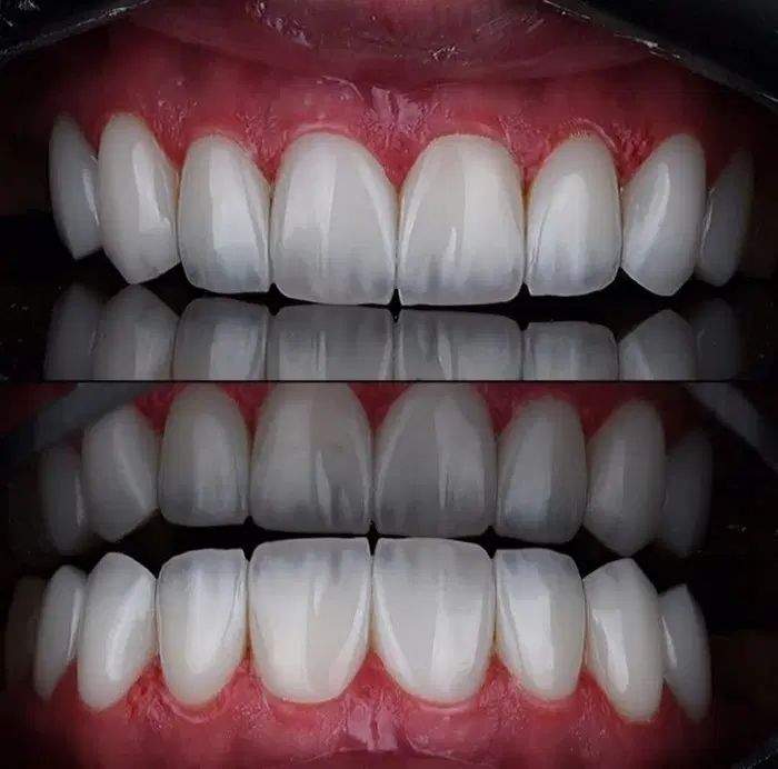 کامپوزیت.لمینت|خدمات آرایشگری و زیبایی|تهران, هفت حوض|دیوار