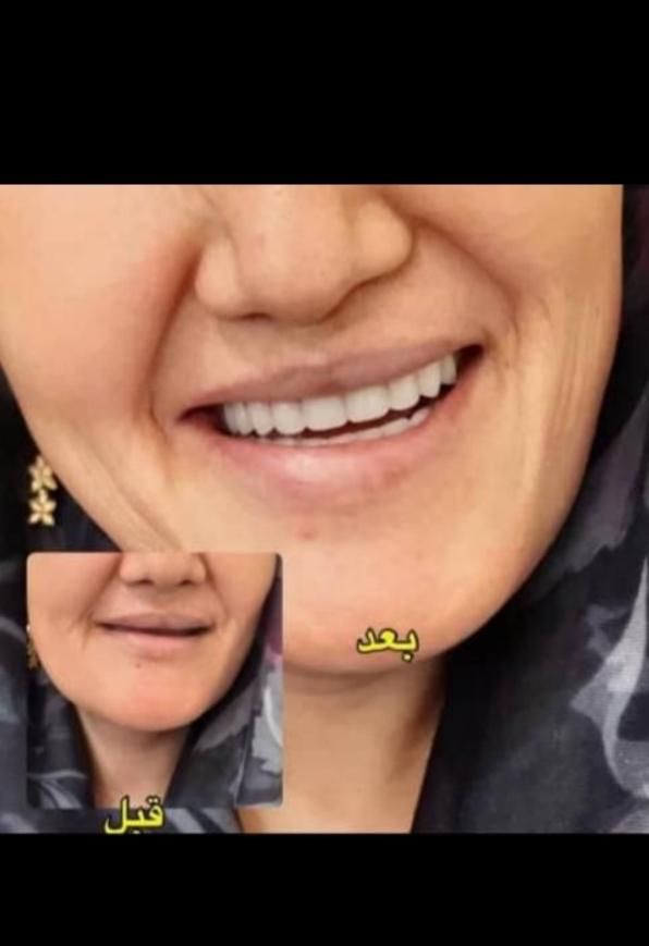 دندانسازی یزدی (قرارداد با بیمه )|خدمات آرایشگری و زیبایی|شیراز, دارالرحمه|دیوار