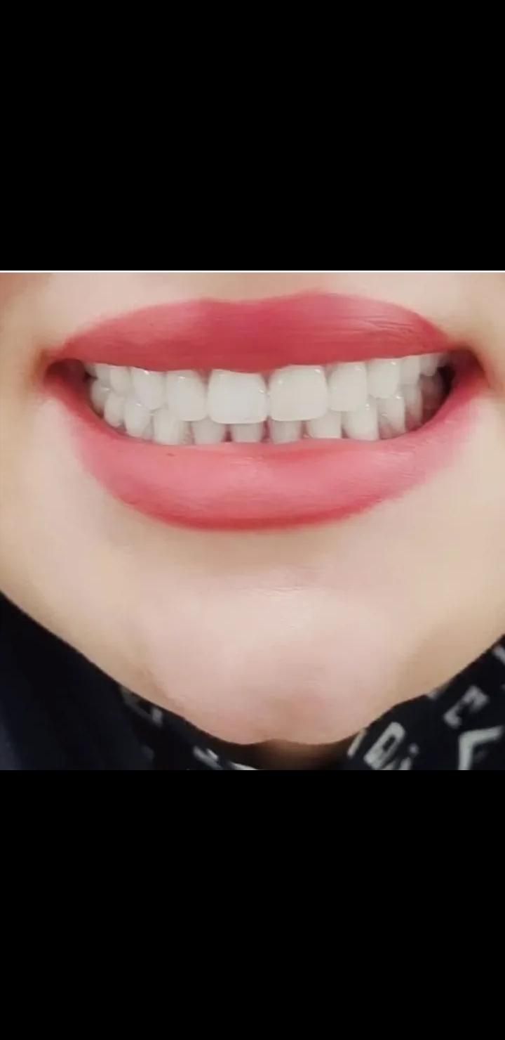 دندانسازی ساخت دندان مصنوعی|خدمات آرایشگری و زیبایی|خرمآباد, |دیوار