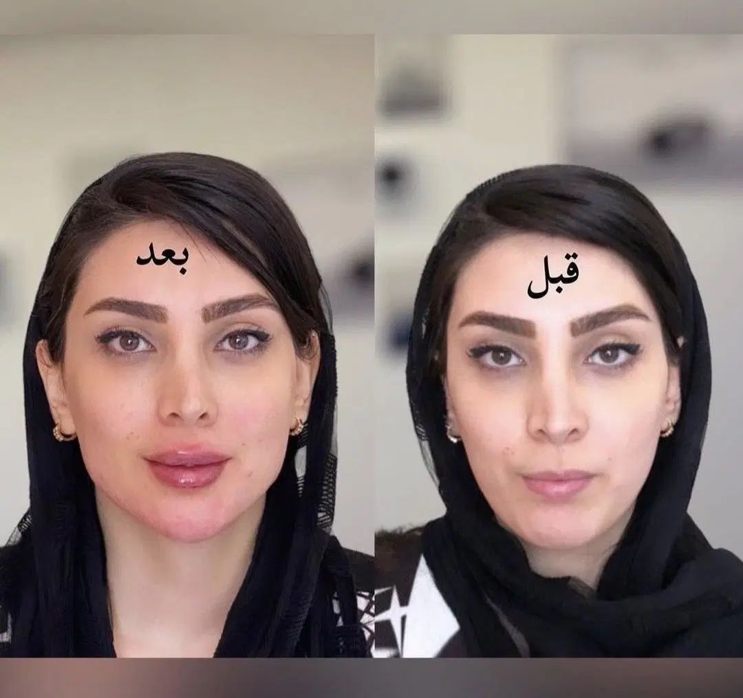فقط فردا ۹۸۰ /کانتورینگ/فیلر/تعدادمحدود|خدمات آرایشگری و زیبایی|رشت, کوی حسینی|دیوار