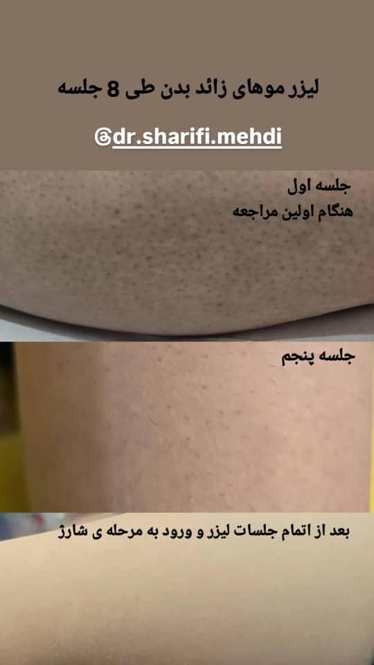 لیزر موهای زائد|خدمات آرایشگری و زیبایی|فولادشهر, B5|دیوار