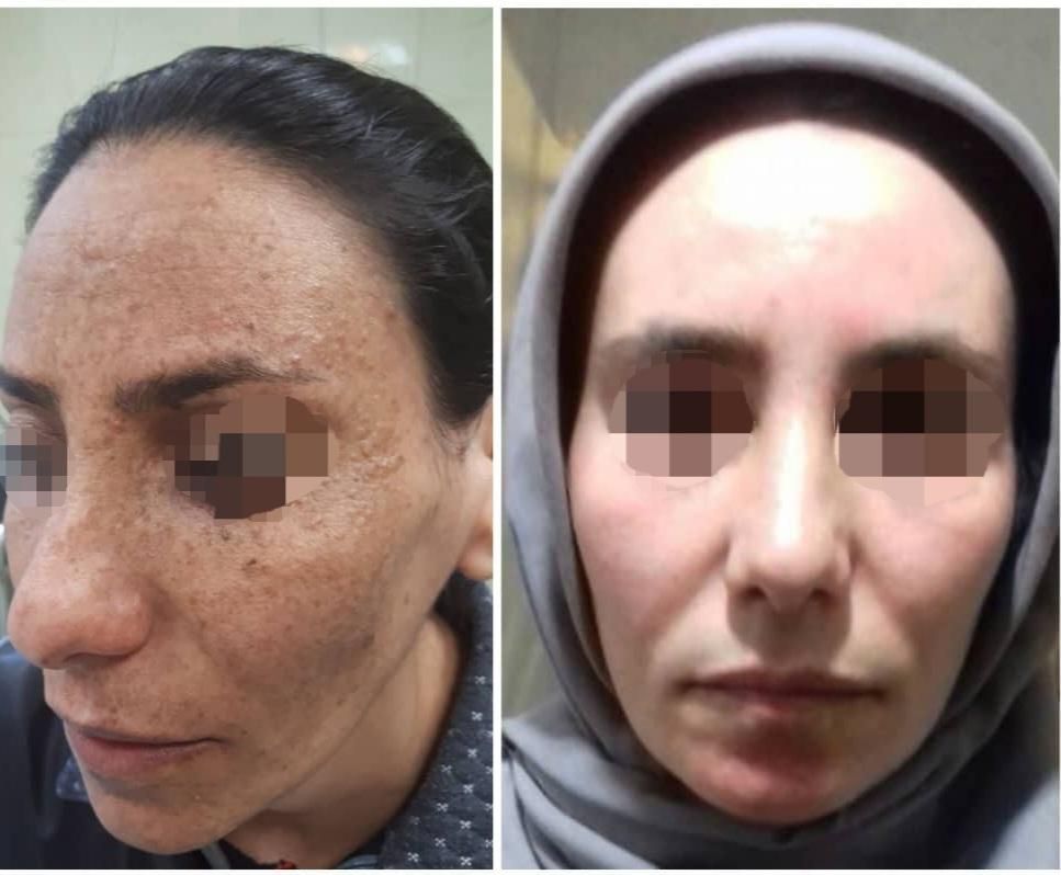 لیزر co2تک جلسه ای،تزریق چربی ودیگر خدمات زیبایی|خدمات آرایشگری و زیبایی|یاسوج, |دیوار