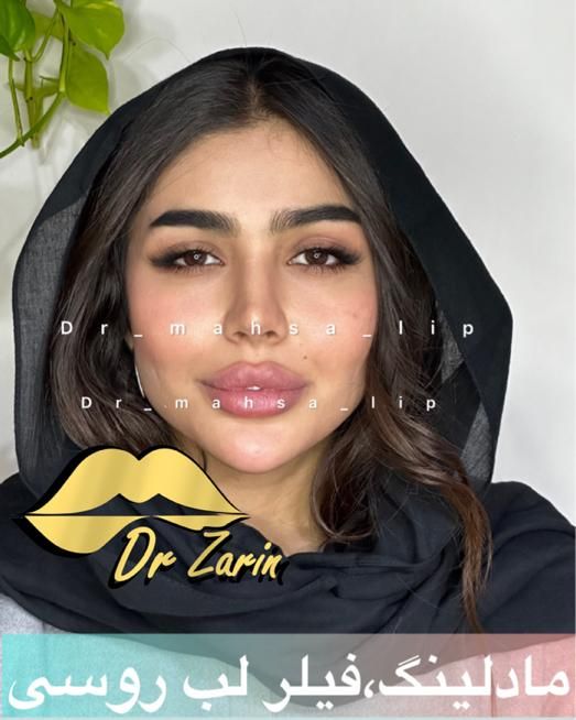 تزریق ژل بوتاکس زاویه فک گونه شقیقه فیلرلب روسی|خدمات آرایشگری و زیبایی|تهران, پونک|دیوار