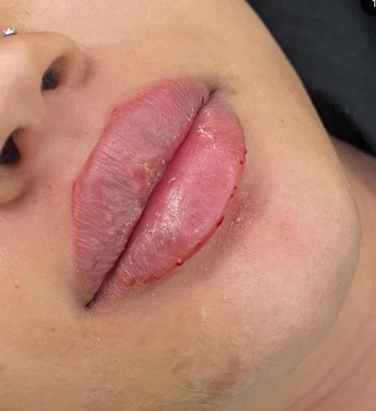 تخفیف فیلروبوتاکس مزو،درمطب پزشک|خدمات آرایشگری و زیبایی|سنندج, |دیوار