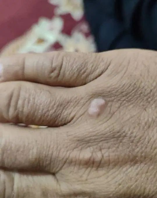 بهبود قطععی زگیل و تبخال تنا.سلی تضمیینی|آرایشی، بهداشتی، درمانی|مشهد, رضاشهر|دیوار