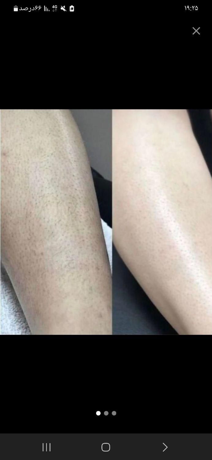 لیزر موهای زائد بدن بدون درد صددرصد تضمینی|خدمات آرایشگری و زیبایی|تهران, میدان ولیعصر|دیوار