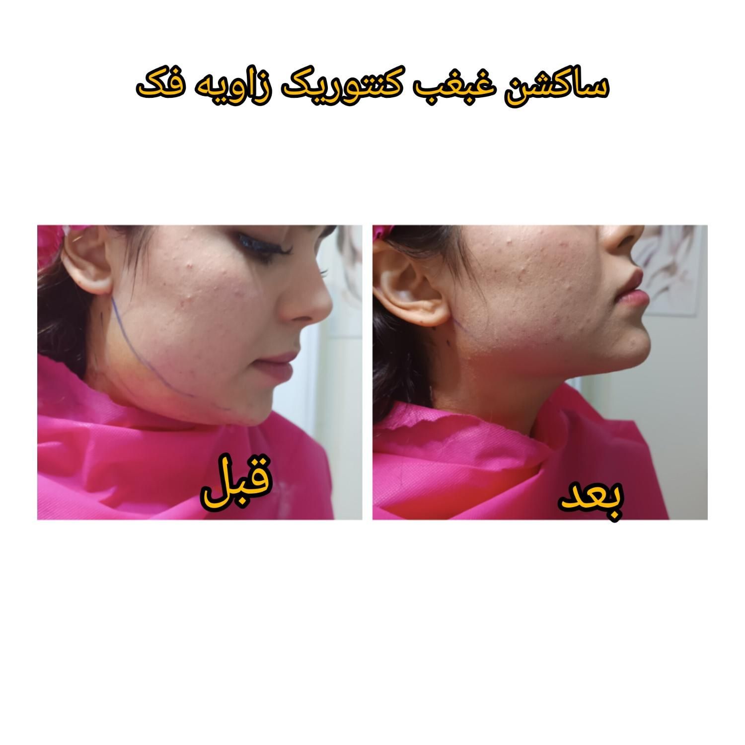 ساکشن چربی بلفاروپلاستی لابیاپلاستی ژل بوتاکس|خدمات آرایشگری و زیبایی|شیراز, ملاصدرا|دیوار