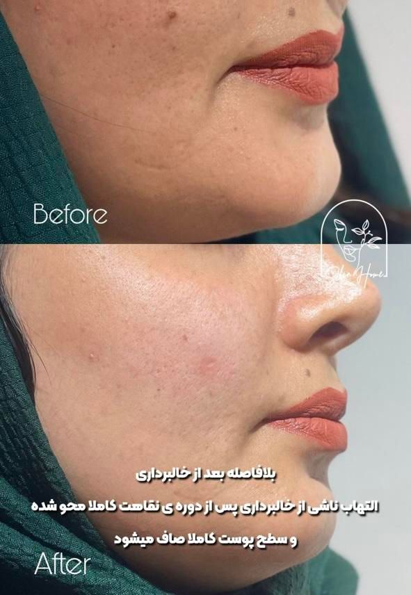 برداشت انواع خال صورت و بدن|خدمات آرایشگری و زیبایی|اهواز, کیانپارس |دیوار