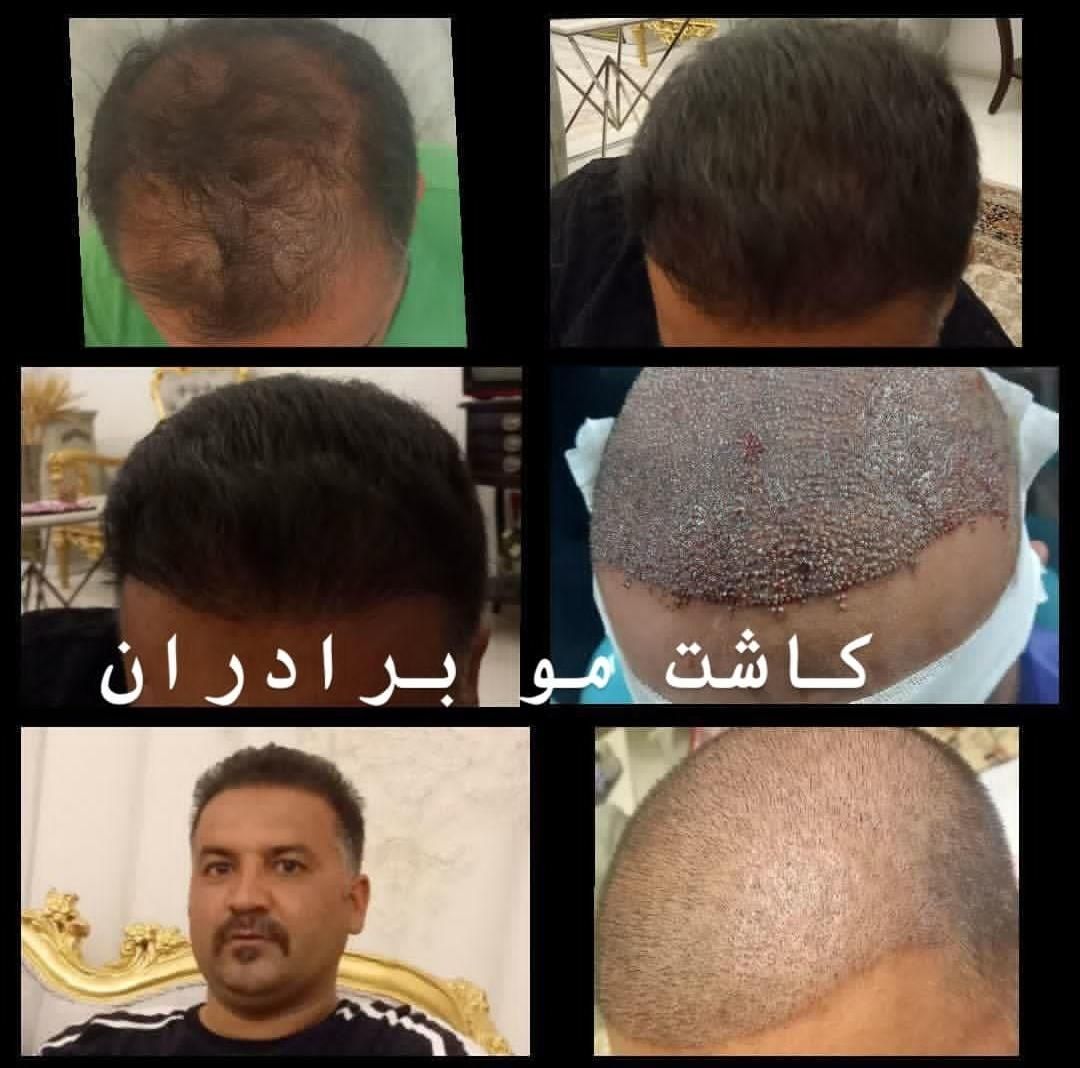 کاشت مو و ابرو در تبریز، پیش پرداخت ۶میلیون|خدمات آرایشگری و زیبایی|اردبیل, |دیوار