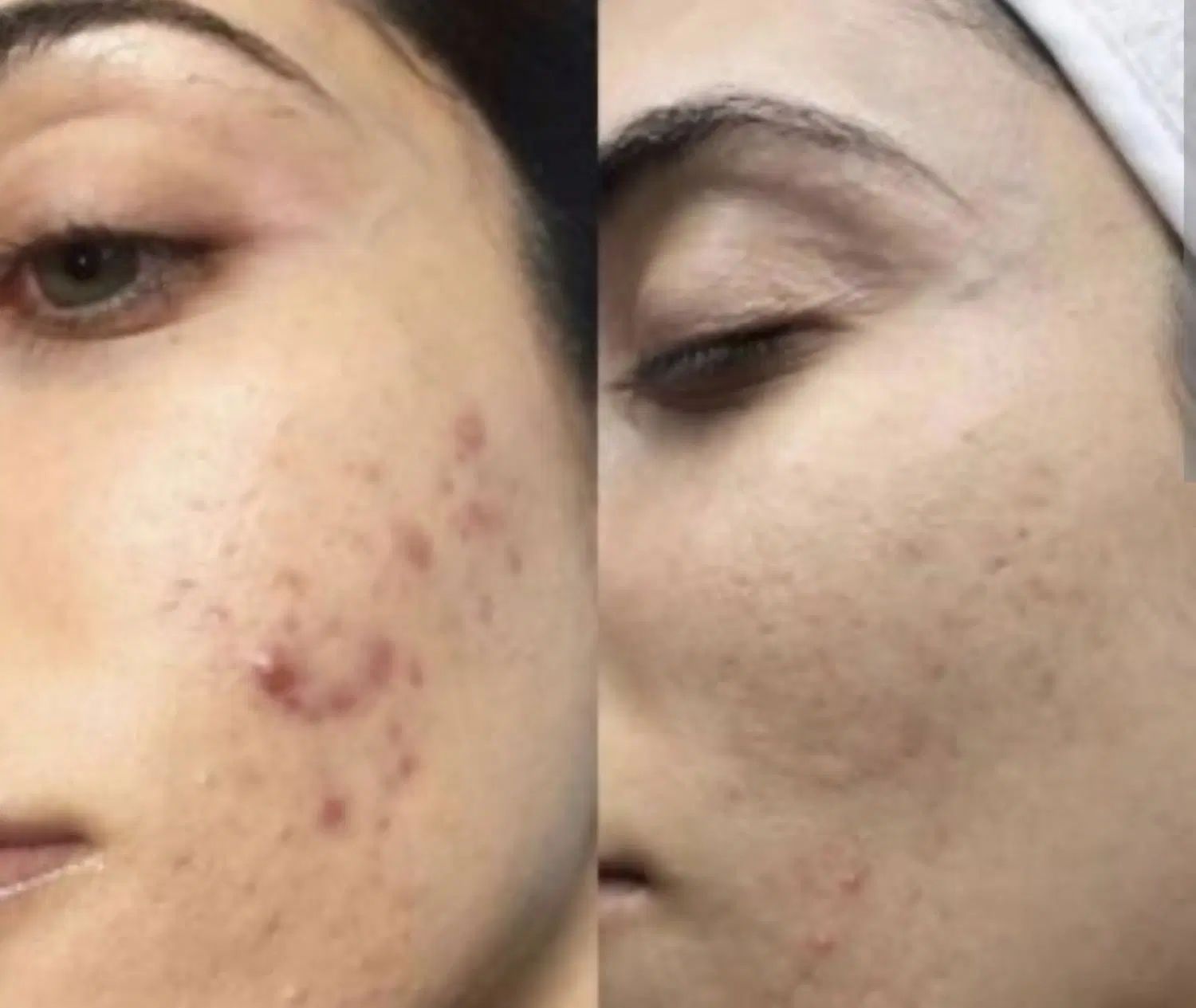تکنیک پوست مار یا الگاپیل، اسپیکول تراپی|خدمات آرایشگری و زیبایی|شیراز, فضل‌آباد|دیوار