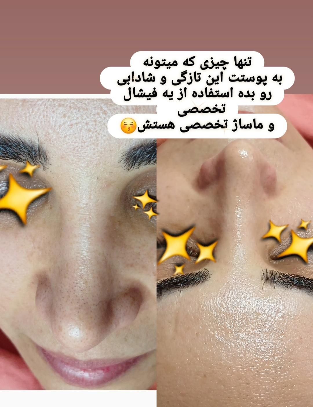 پاکسازی و فیشال تخصصی و درمانی با بهترین برندها|خدمات آرایشگری و زیبایی|پرند, فاز ۲|دیوار