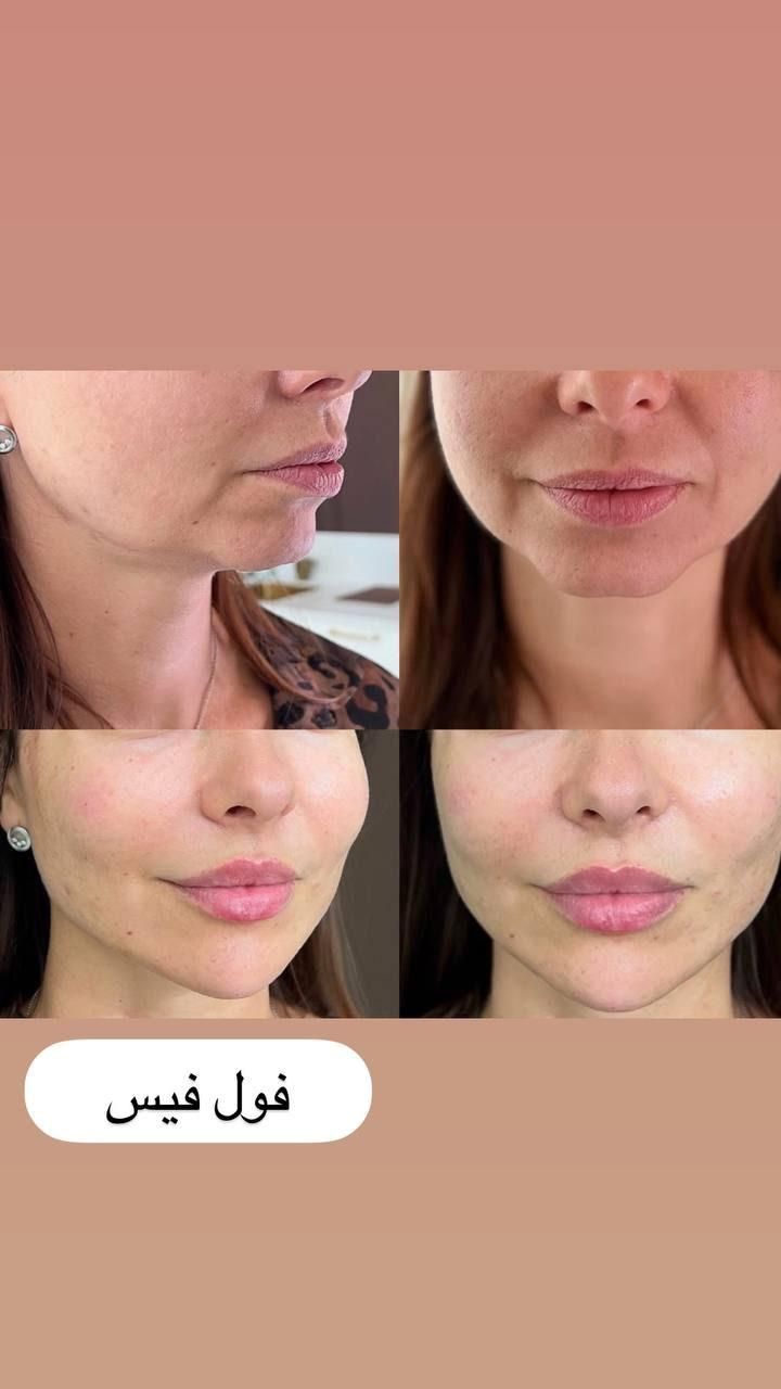 ژل لب ،زاویه سازی،فیلر چانه ،فول فیس|خدمات آرایشگری و زیبایی|مشهد, سجاد شهر|دیوار