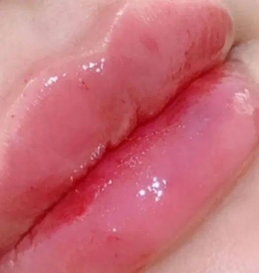 تزریق ژل،بوتاکس،پی آرپی،مزو تراپی،پلاسما جت|خدمات آرایشگری و زیبایی|بندر امام خمینی, |دیوار