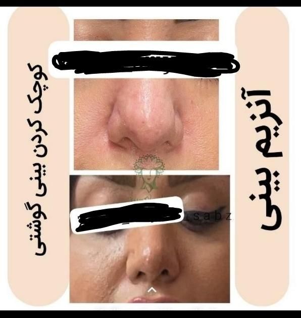 انزیم بینی|خدمات آرایشگری و زیبایی|الشتر, |دیوار