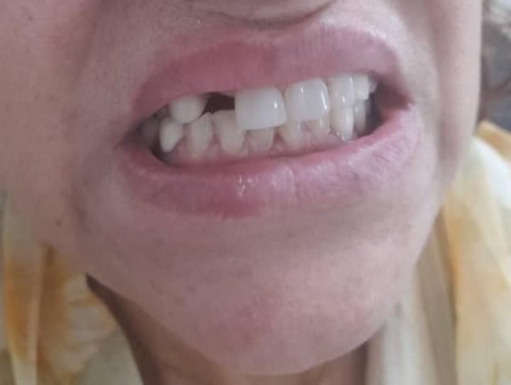 ساخت دندان مصنوعی فلیپر (تک واحدی و دو واحدی)|خدمات آرایشگری و زیبایی|آمل, |دیوار