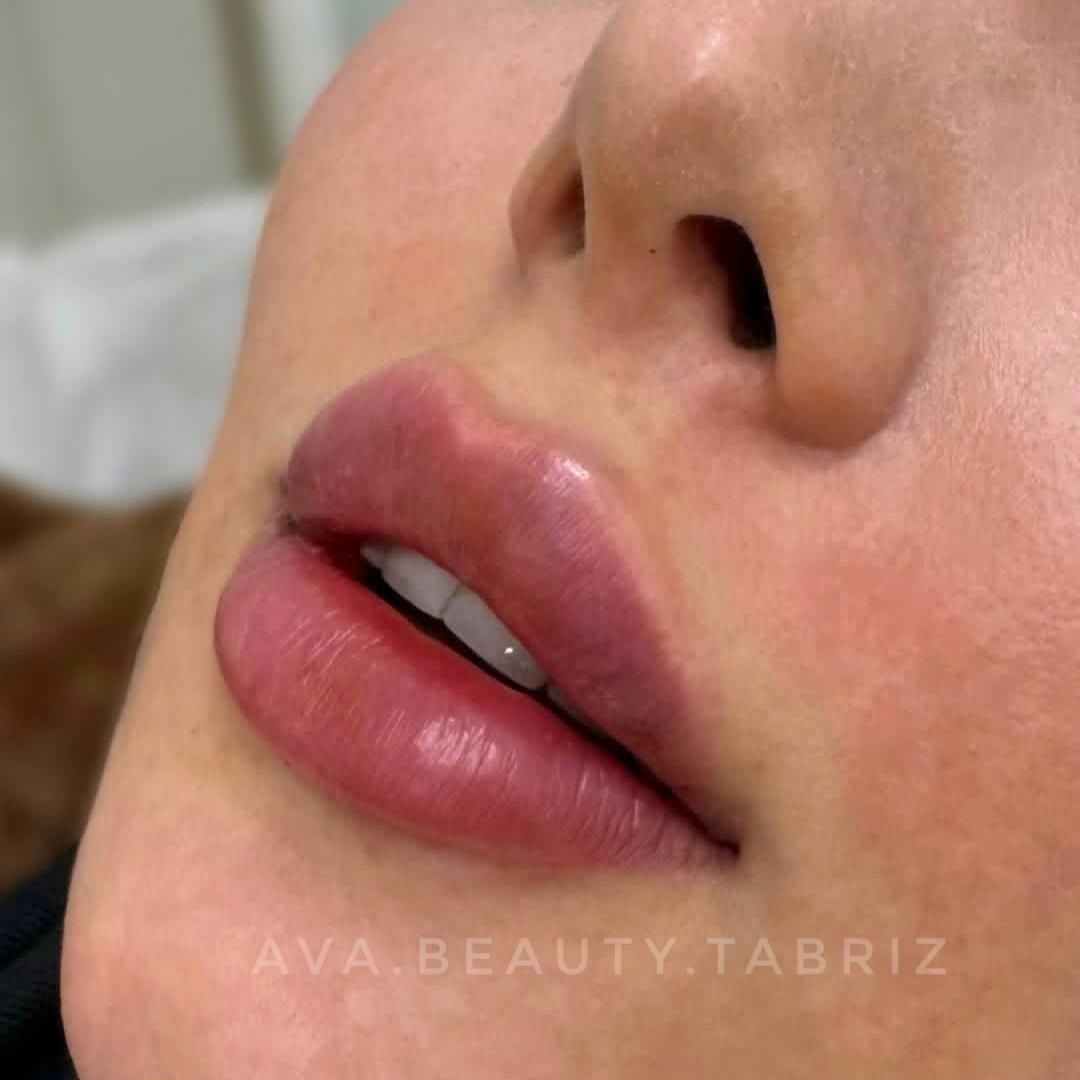 تزریق تخصصی فیلرلب بدون درد و باتضمین|خدمات آرایشگری و زیبایی|تبریز, |دیوار