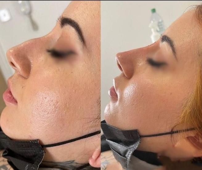 فیلر بینی  برطرف کردن قوز بینی  بینی شکسته و کج|خدمات آرایشگری و زیبایی|خرم‌آباد, |دیوار