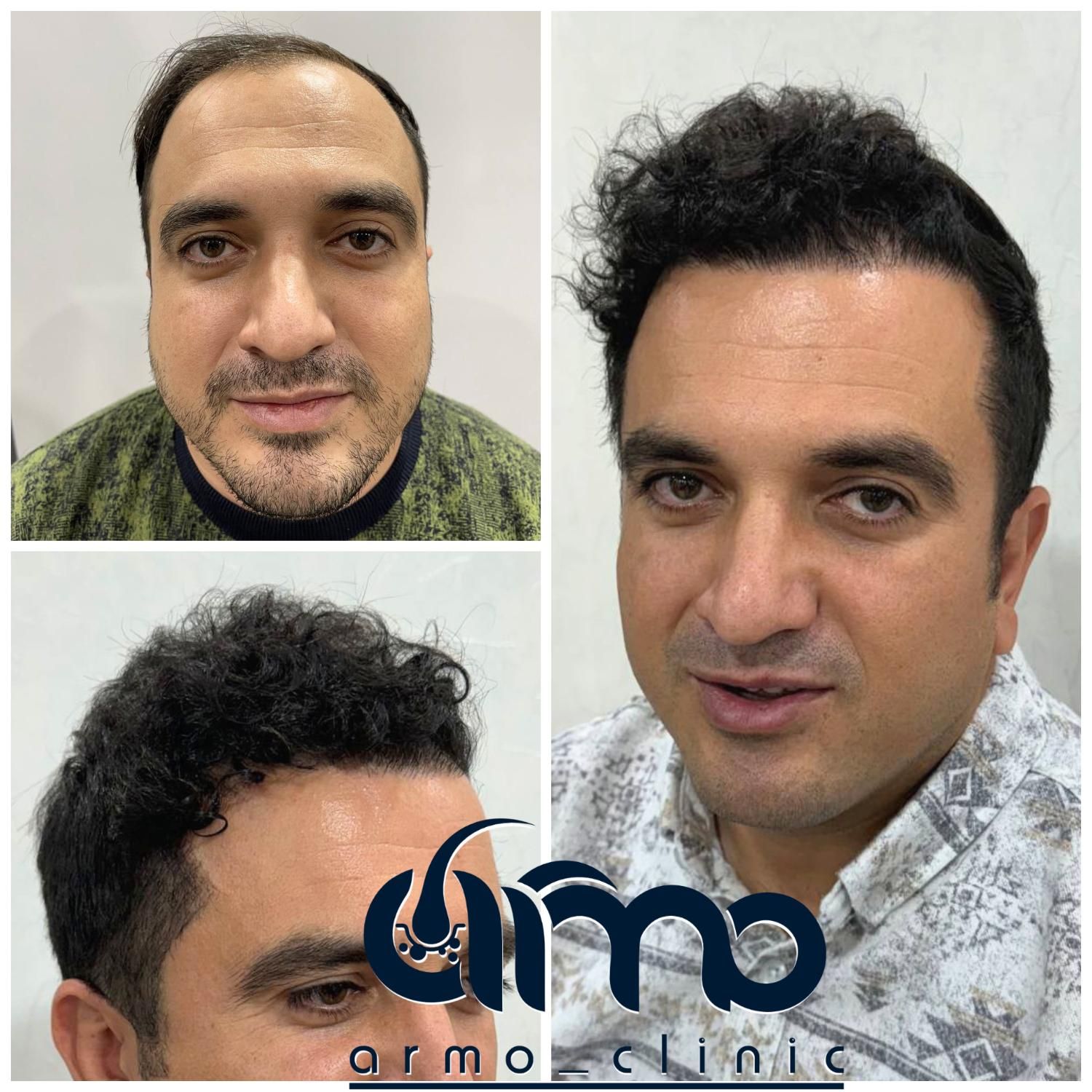 کاشت مو ابرو ریش تکنسین شیرازی|خدمات آرایشگری و زیبایی|قزوین, |دیوار