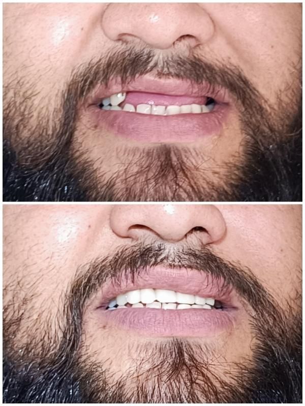 دندان دندانسازی پروتز با چک|خدمات آرایشگری و زیبایی|مشهد, موعود|دیوار