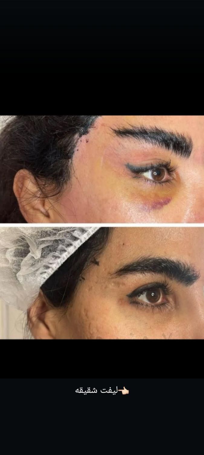 لیپو ابدو کاشت مو ابرو تزریق چربی ژل بوتاکس بلفارو|خدمات آرایشگری و زیبایی|اهواز, نادری|دیوار