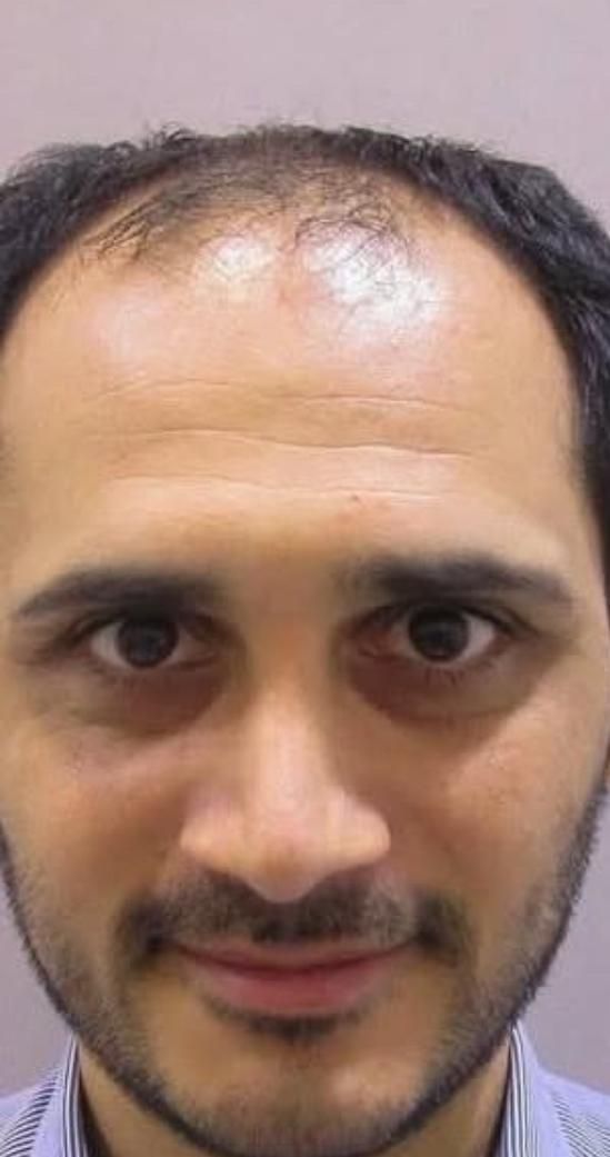 کاشت مو و‌یک جلسه مزوتراپی یک جلسه پی آر پی رایگان|خدمات آرایشگری و زیبایی|تهران, جردن|دیوار