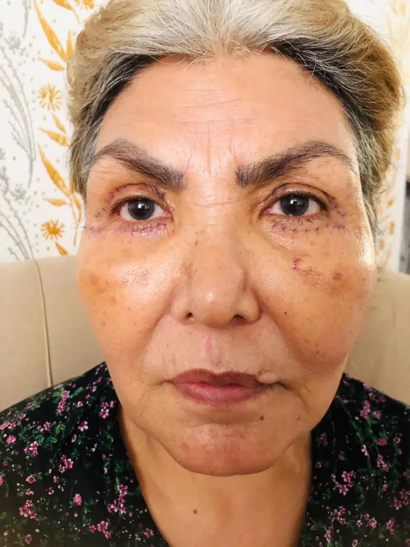 بلفاروپلاستی با۲تومن تخفیف فقط فردا ۳عصر|خدمات آرایشگری و زیبایی|قم, بلوار امین و ساحلی|دیوار