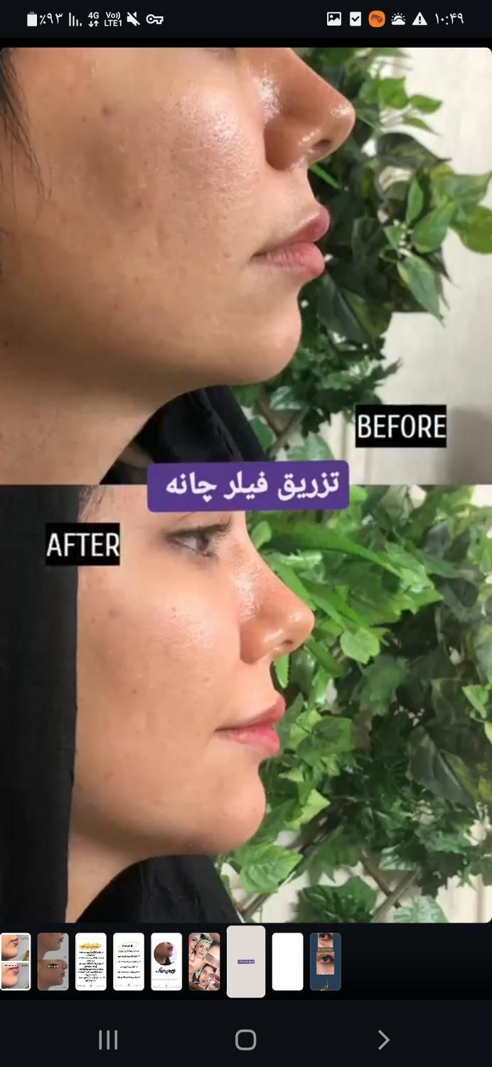 تزریق ژل و بوتاکس توسط پزشک|خدمات آرایشگری و زیبایی|بروجرد, |دیوار